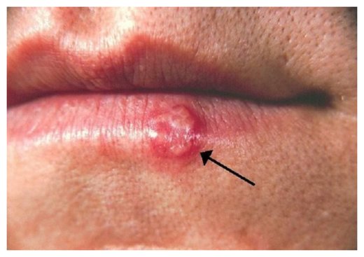 Click to enlarge Herpes simplex