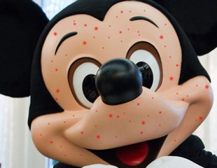 disney measels