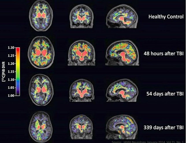 Click to enlarge traumatic brain injury