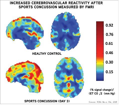 sports brain injury