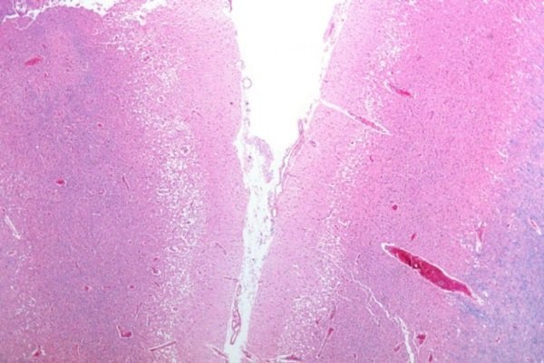 Click to enlarge cortical pseudolaminar necrosis, stroke condition