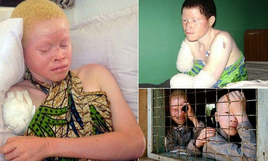 Albinism