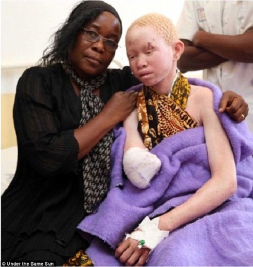 Click to enlarge Albinism
