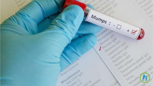 Click to enlarge mumps