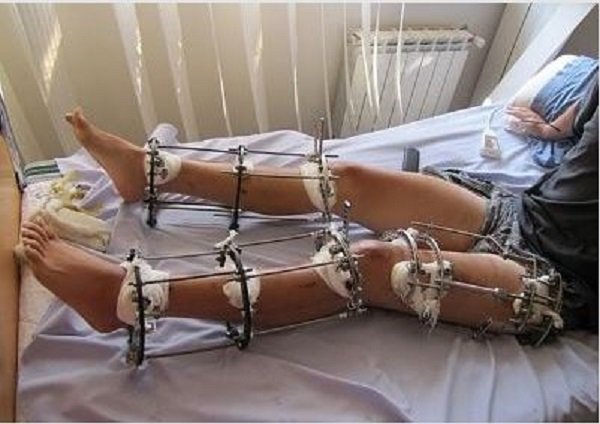 limb lengthening surgery