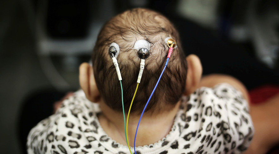Baby with microencephaly