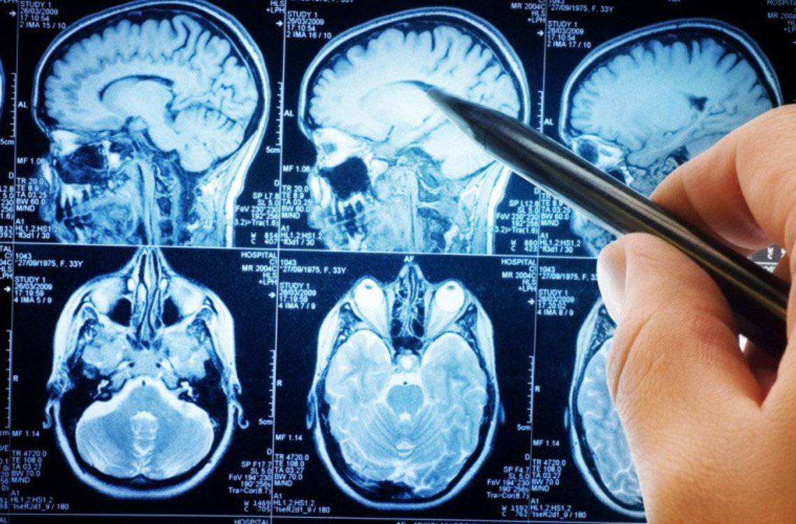 brain scan