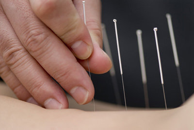 Click to enlarge person inserting acupuncture needles