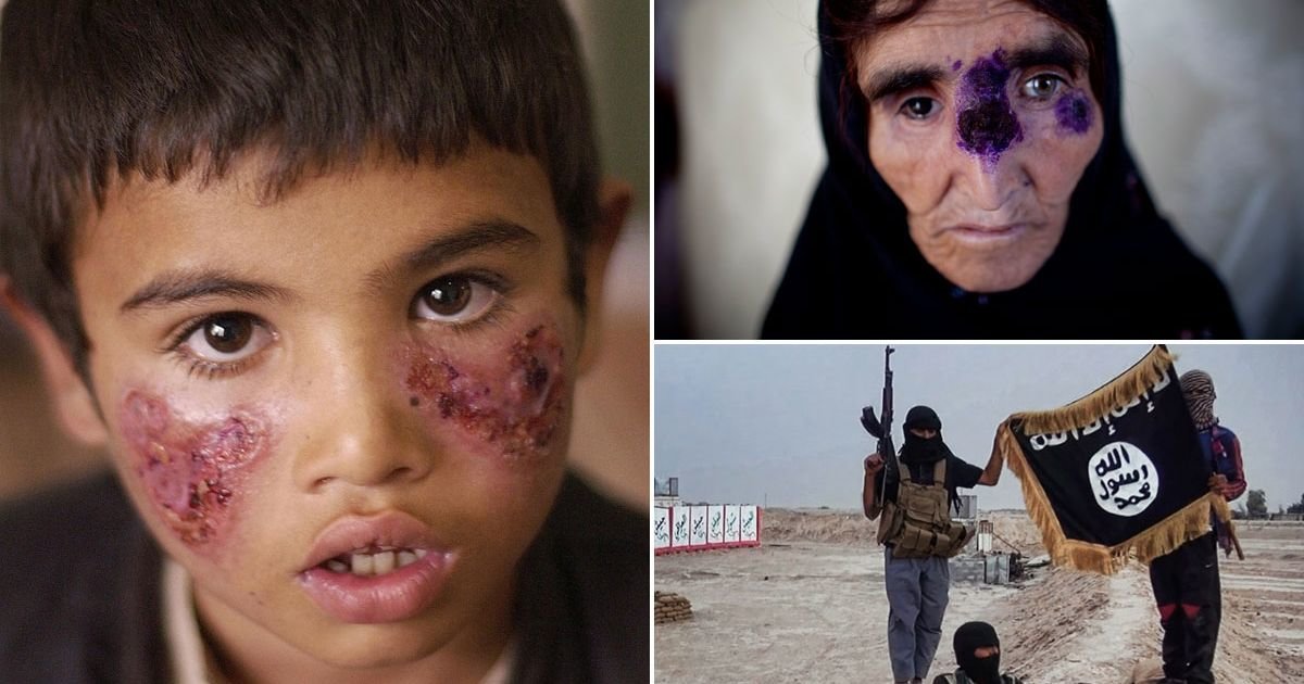 flesh eating disease