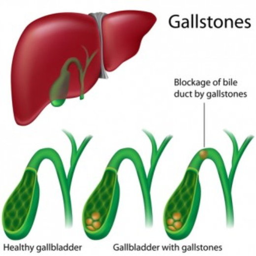 gall stones