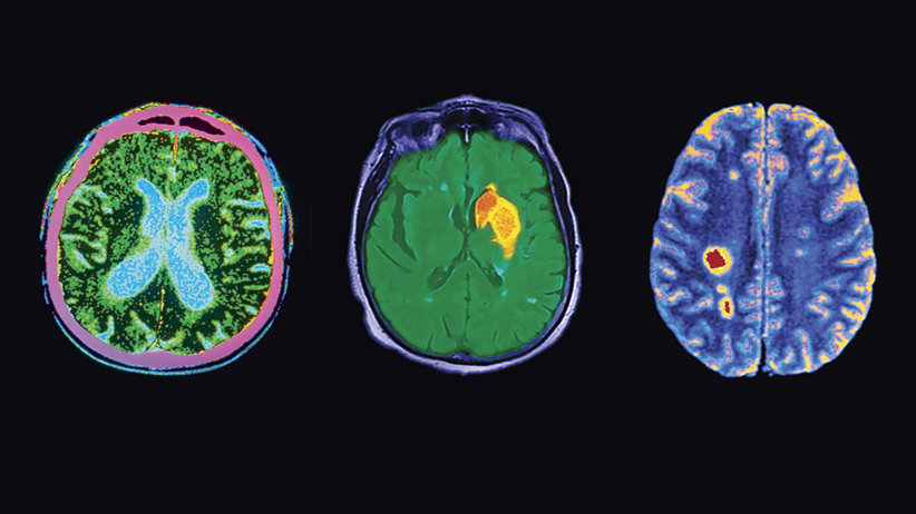 brain healing