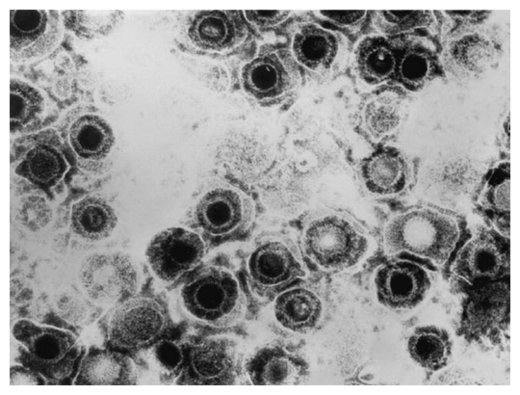 Click to enlarge Herpes simplex virus