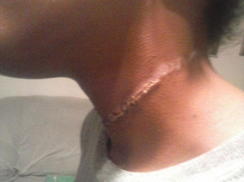 neck rope injury