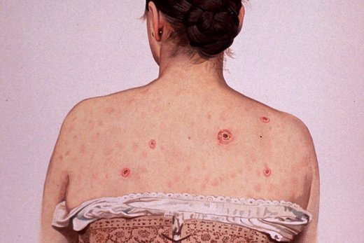 Click to enlarge syphilis