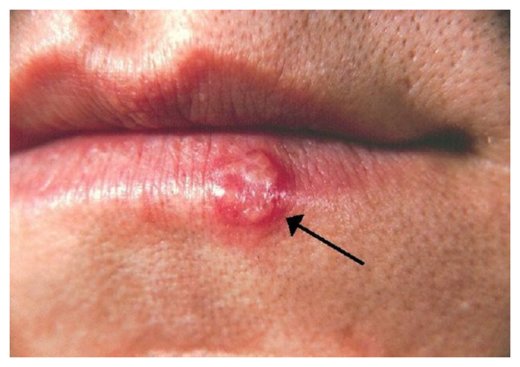 Herpes simplex