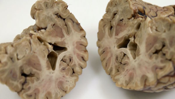 Click to enlarge brain