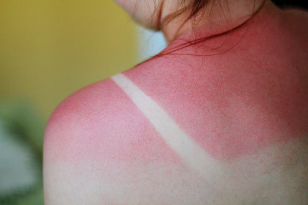 Click to enlarge sunburn