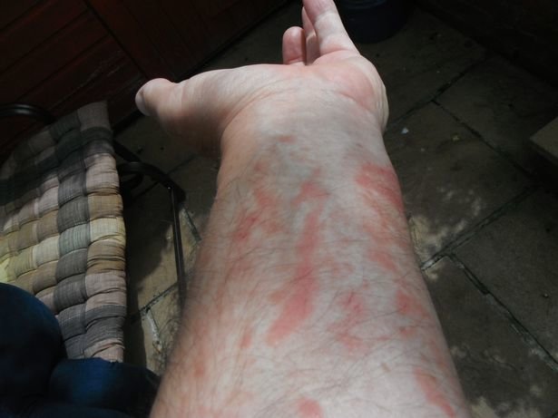 giant hogweed burns