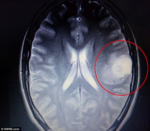 Click to enlarge brain tumor