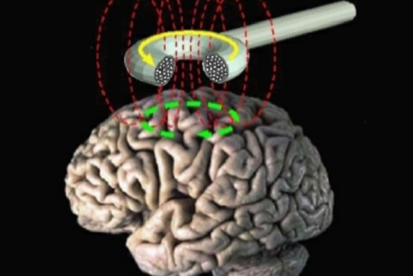 Transcranial magnetic stimulation