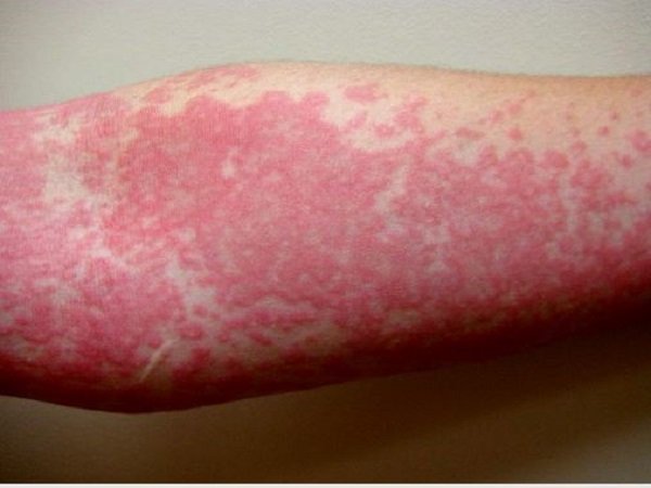 hives