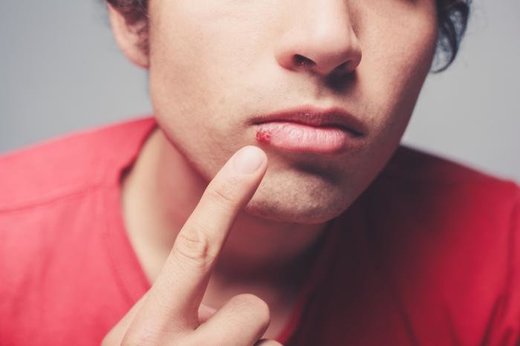 Click to enlarge cold sore