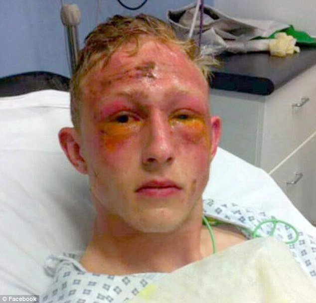 acid attack