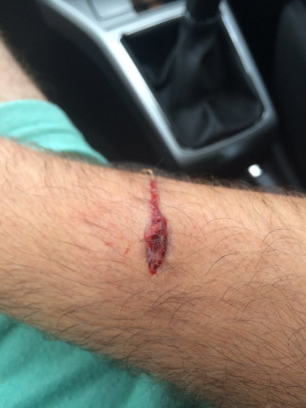 The puncture the cat left in Darrens arm 