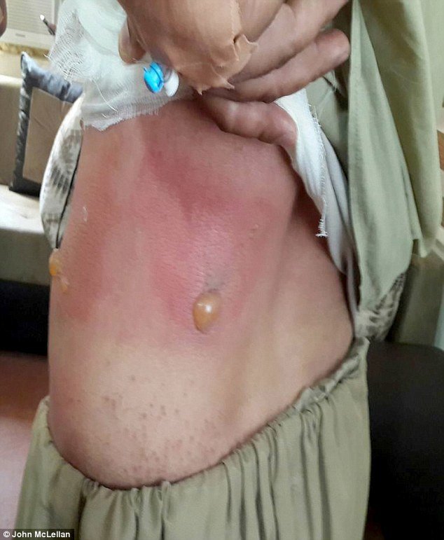 Kurdish fighter Mirmaj Hassan and the blisters on his abdomen