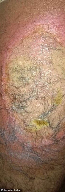 Click to enlarge Blistering on Kurdish victims' arm, left and right