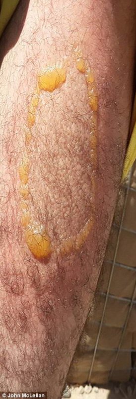 Click to enlarge Blistering on Kurdish victims' arm, left and right