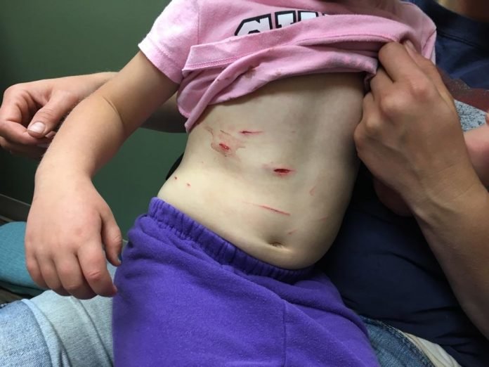 Kelsi Butt, 4, of Blackfoot, Idaho shows some of the wounds she suffered when a mountain lion grabbed her and tried to drag her away. 