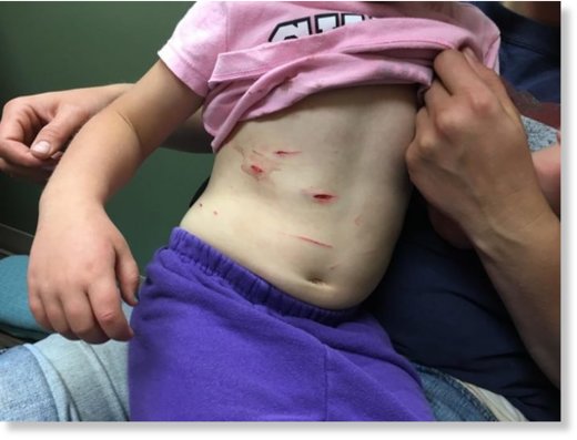Kelsi Butt, 4, of Blackfoot, Idaho shows some of the wounds she suffered when a mountain lion grabbed her and tried to drag her away. 