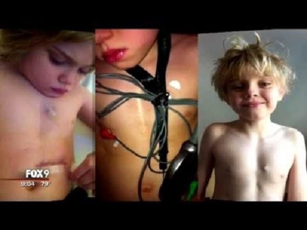 boy with pacemaker