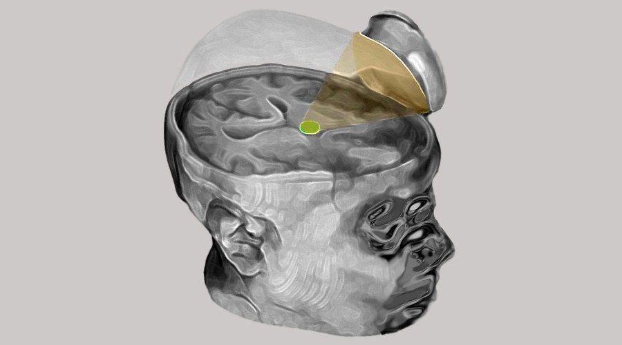 brain device