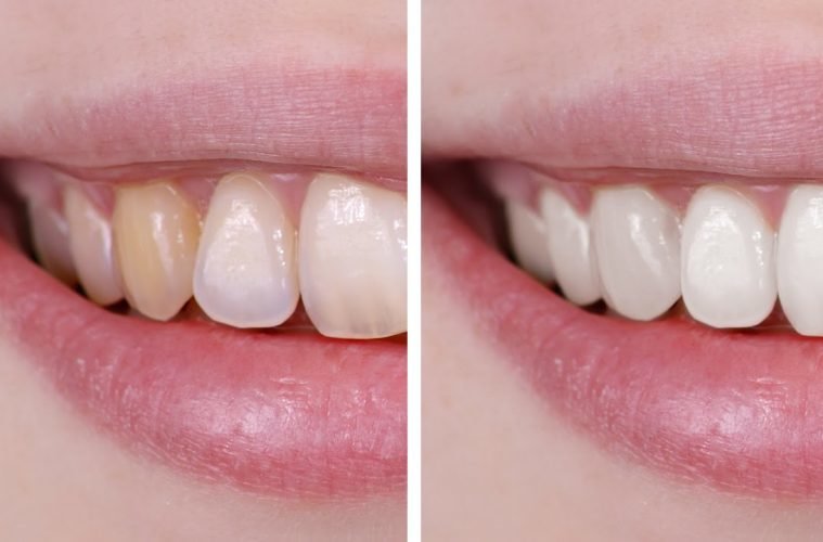 tooth whitening