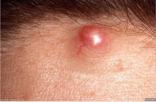 cyst