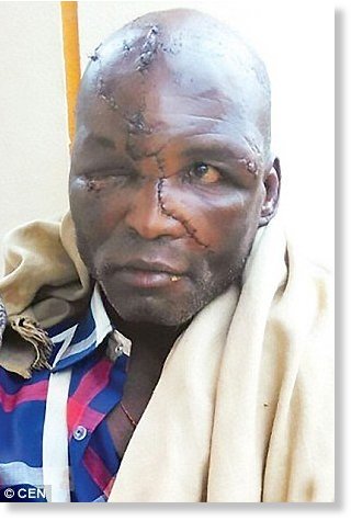 Click to enlarge Jube Valanti Adveppache, 58, survived a three-hour bear attack in southern India after he was mauled by a Sloth bear
