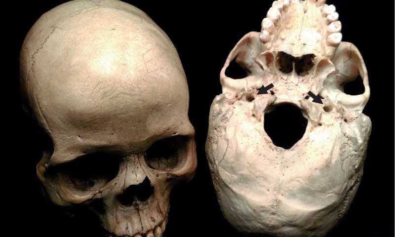 Click to enlarge Human skulls carotid arteries