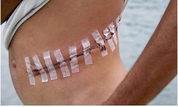 kidney removal scar