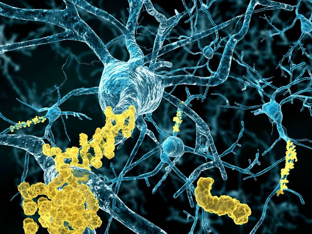 Alzheimer, Demenz