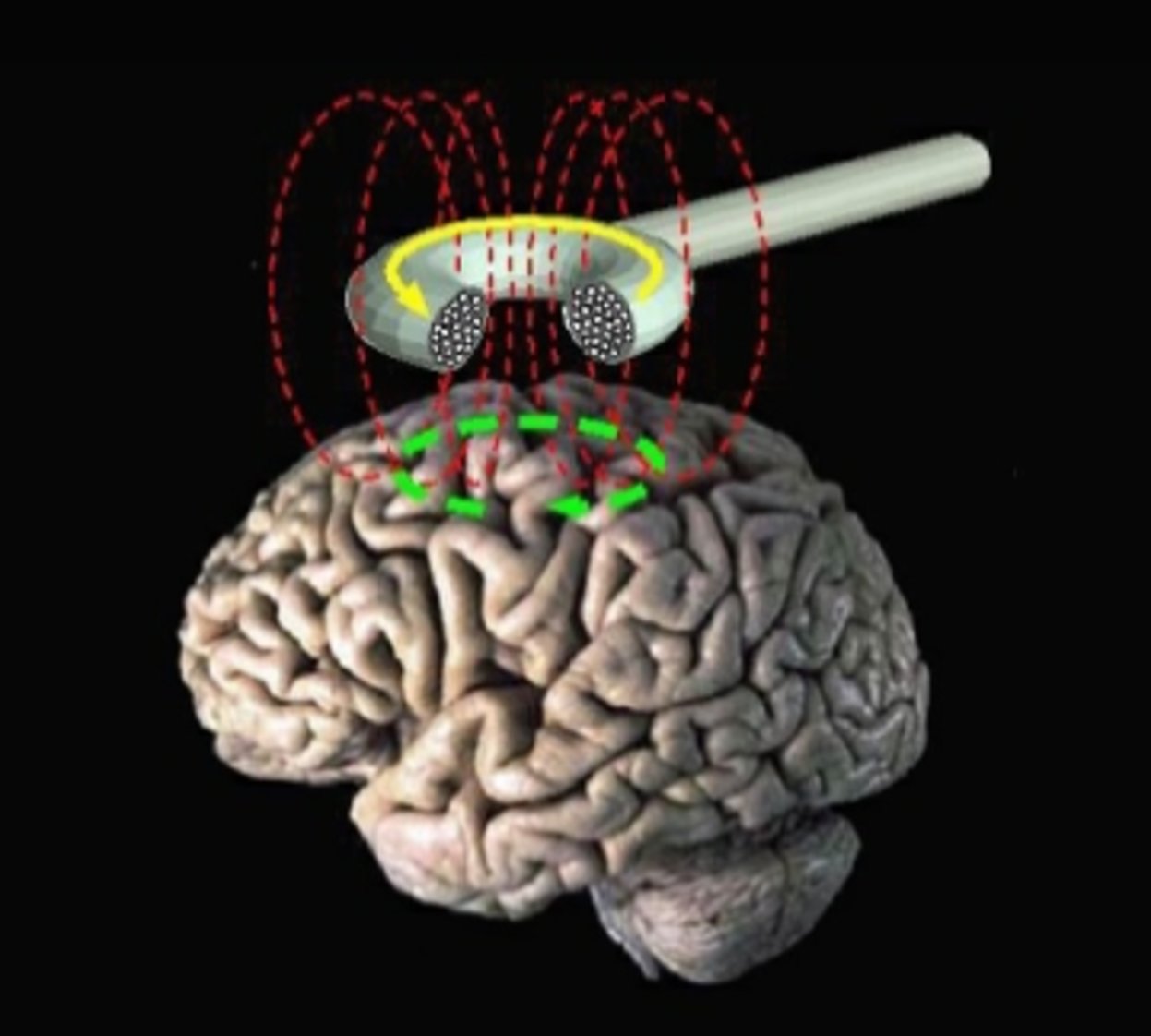 transcranial magneti stimulation