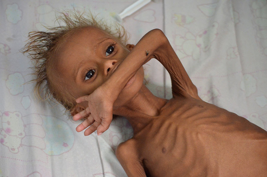 Click to enlarge starving yemen children