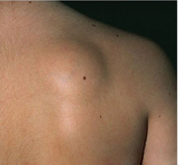 fatty lipoma