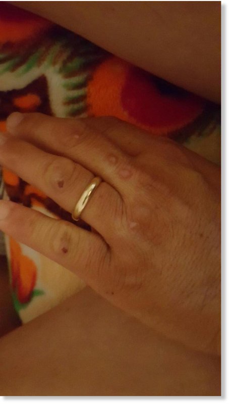 Click to enlarge This photo of David Souvannaphan's hand shows cuts that resulted from the beaver attack.