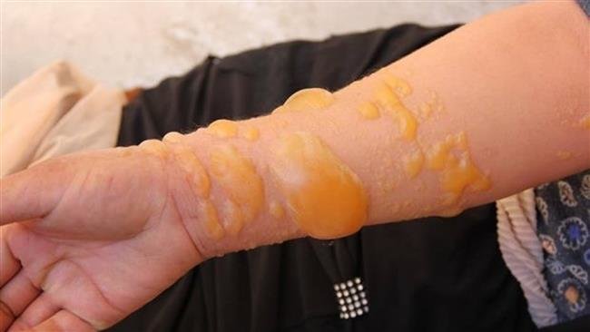 Click to enlarge Painful skin blisters caused by an ISIS chemical weapons