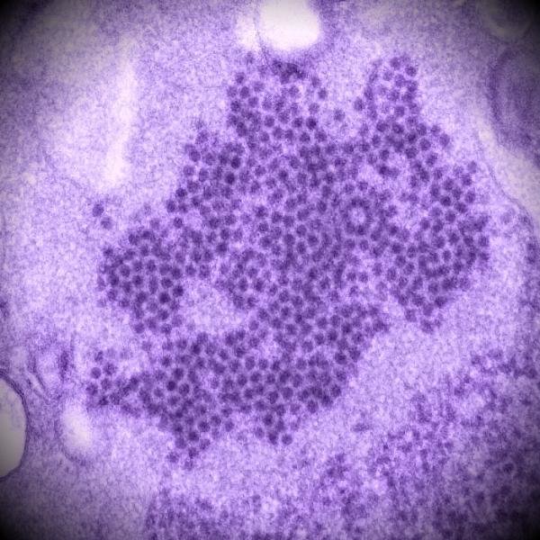 Click to enlarge Acute flaccid myelitis
