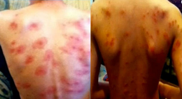 rash