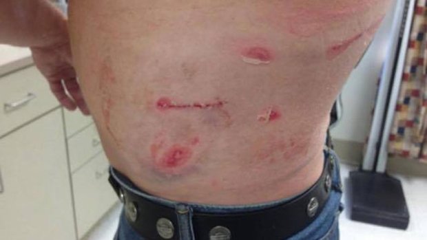 Click to enlarge Lyons suffered several lacerations under his left ribcage during the bear attack.