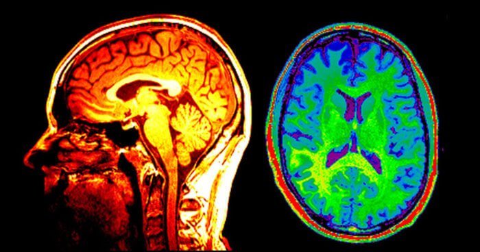 brain scans
